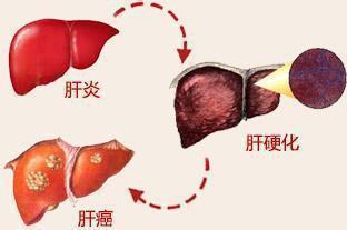 肝癌的病因有哪些？