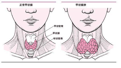 甲状腺癌的治疗方法？