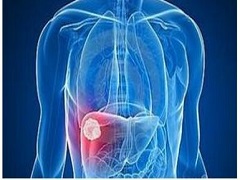 乐伐替尼是治疗晚期肝癌患者的重磅药物 